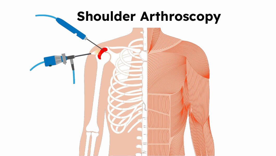 Shoulder Arthroscopy