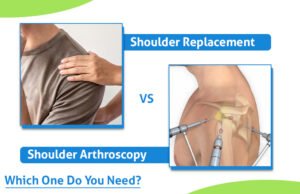 shoulder replacement vs shoulder arthroscopy