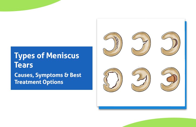Types of Meniscus Tears: Causes, Symptoms & Treatment